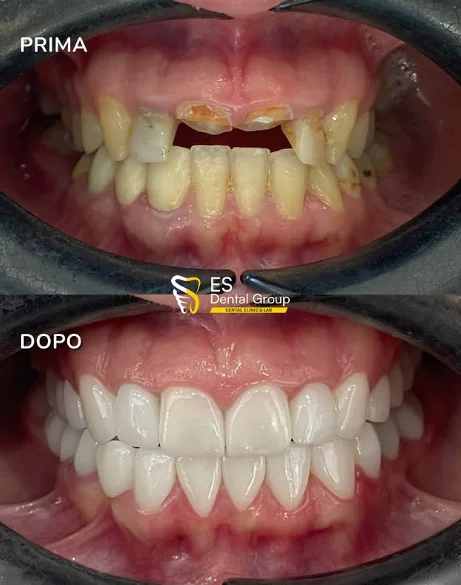 Prima e dopo — disallineamento
