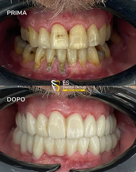 Prima e dopo — tartaro e restauri